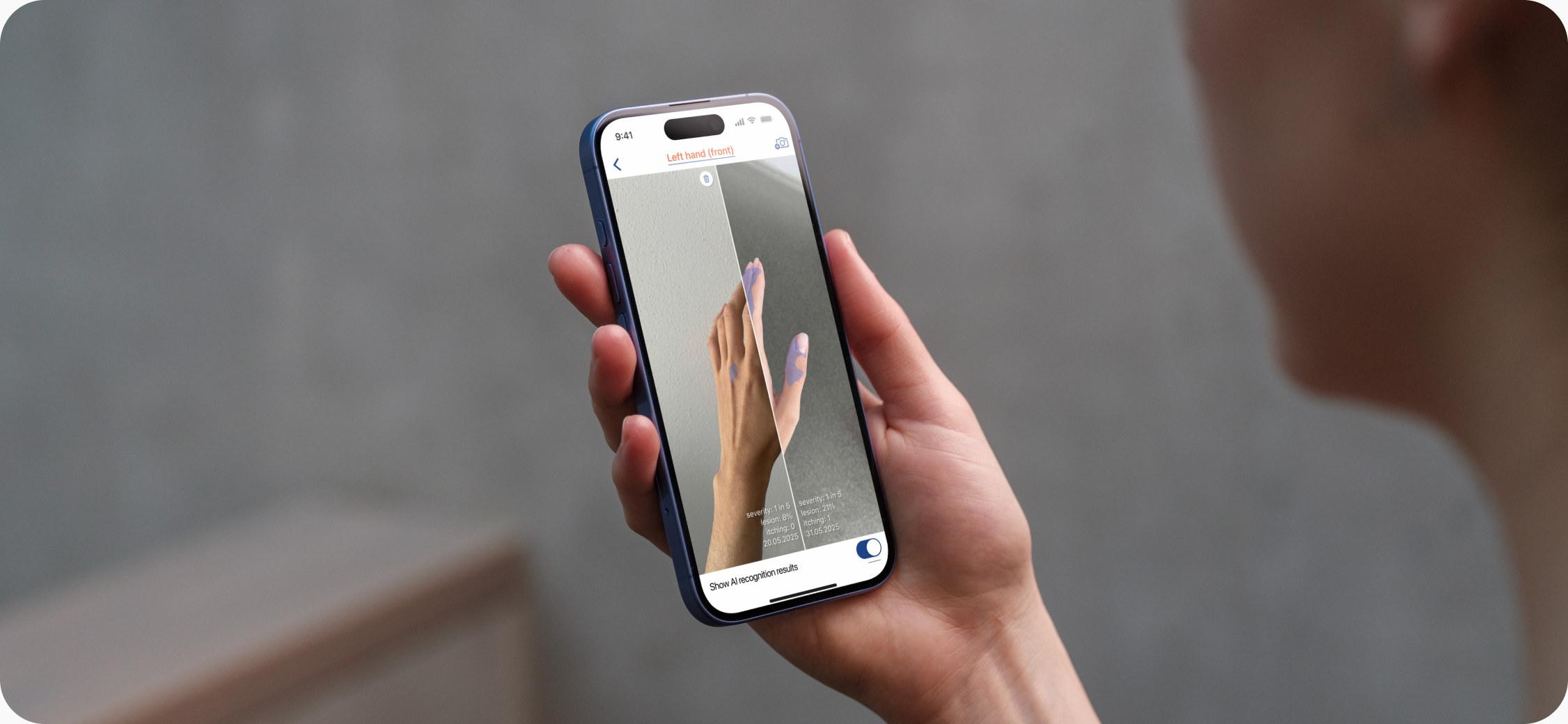 AI-powered eczema app turns skin photos into trackable severity estimates